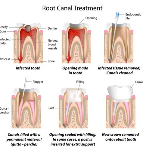 root-canal-treatmen